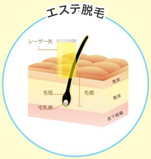 エステ脱毛
