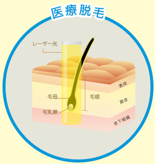 医療脱毛