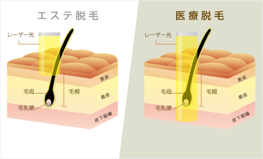 エステ脱毛と医療脱毛の違い