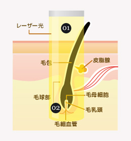 医療レーザー照射図