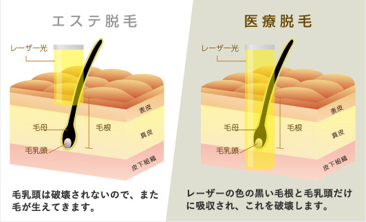 エステ脱毛と医療脱毛の違い