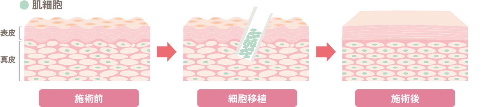 肌再生幹細胞治療