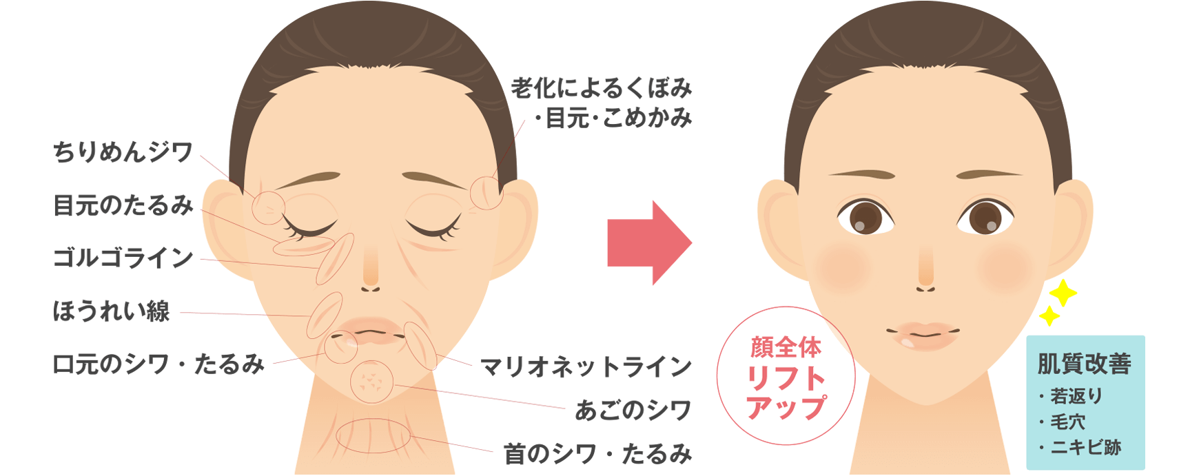 肌再生幹細胞治療